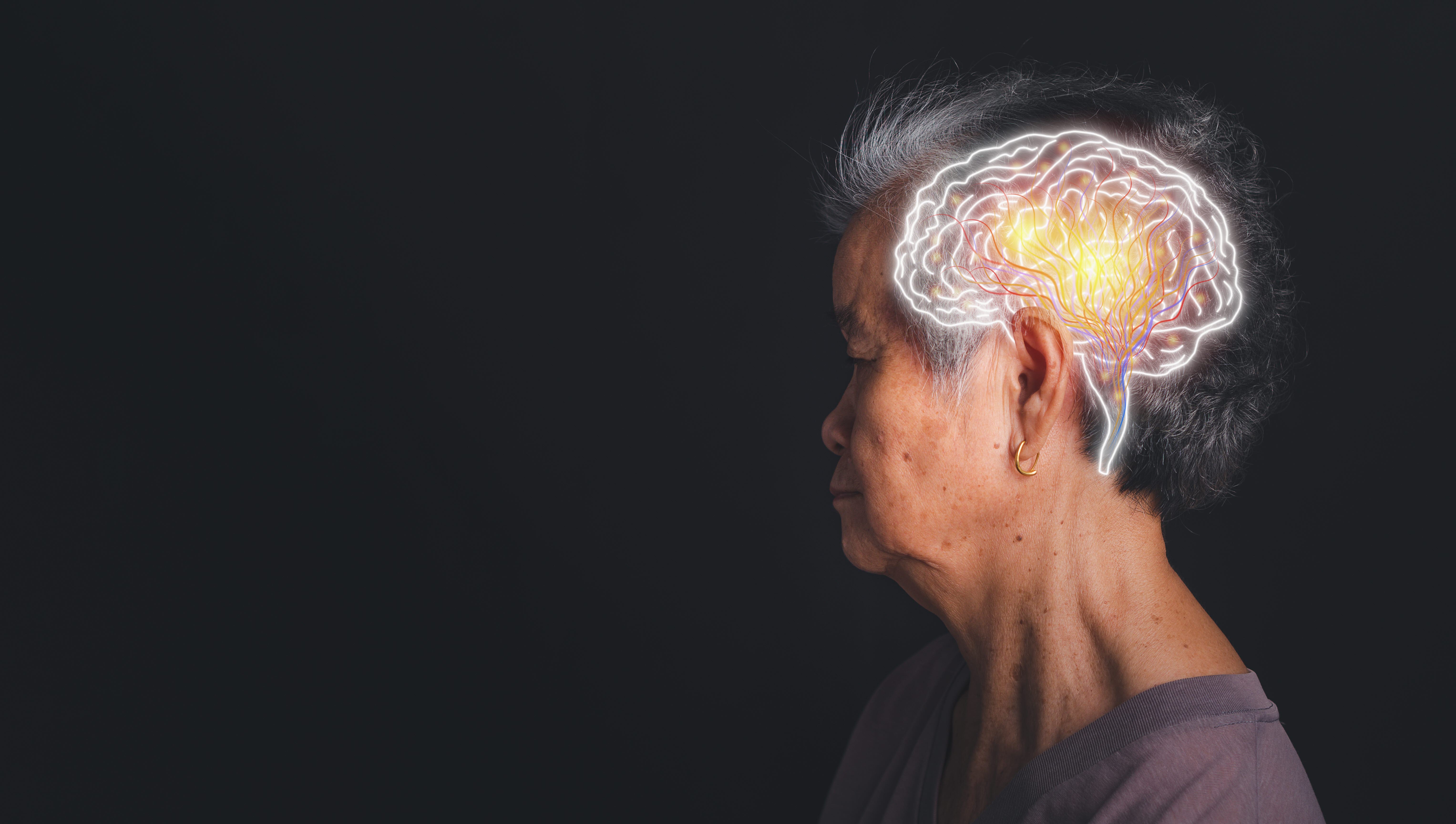 Alzheimer's - how it effects the brain
